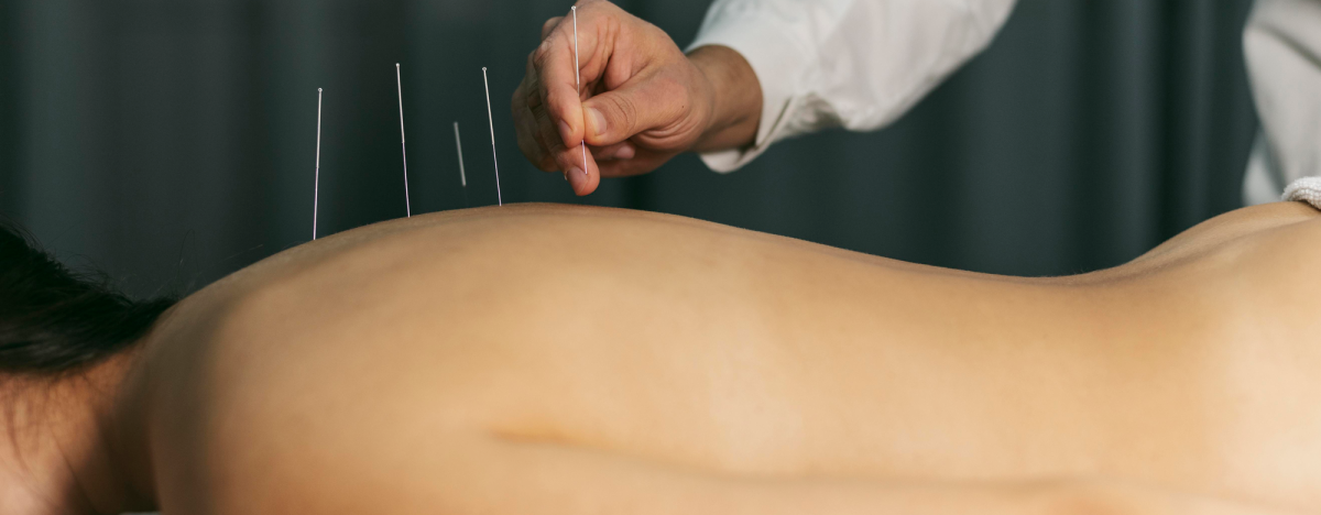 acupuncture-process